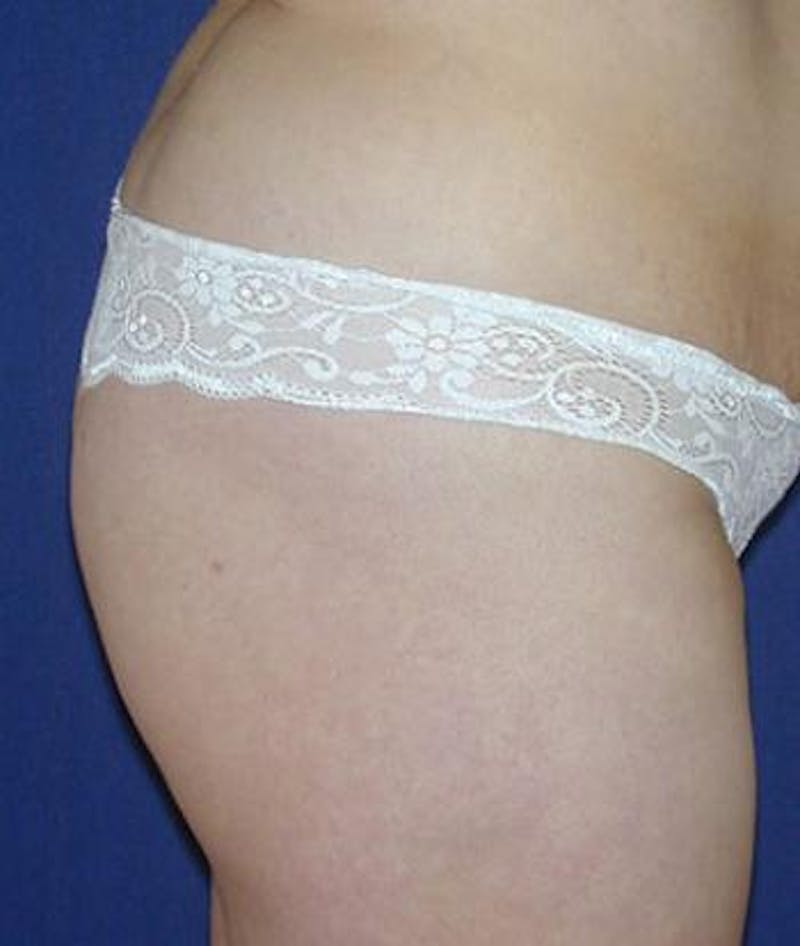 Buttock Lift Before & After Gallery - Patient 152412 - Image 3