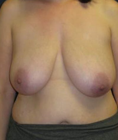 Breast Reduction Before & After Gallery - Patient 284136 - Image 1