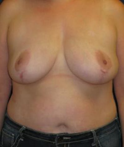 Breast Reduction Before & After Gallery - Patient 284136 - Image 2