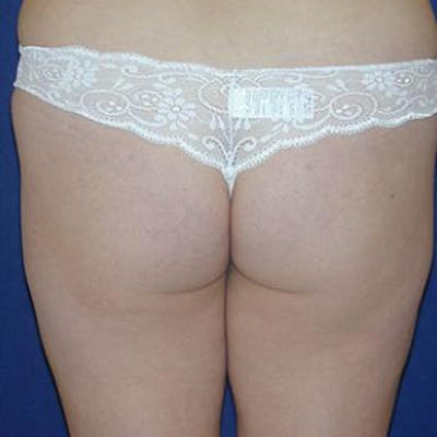 Buttock Lift Before & After Gallery - Patient 152412 - Image 1
