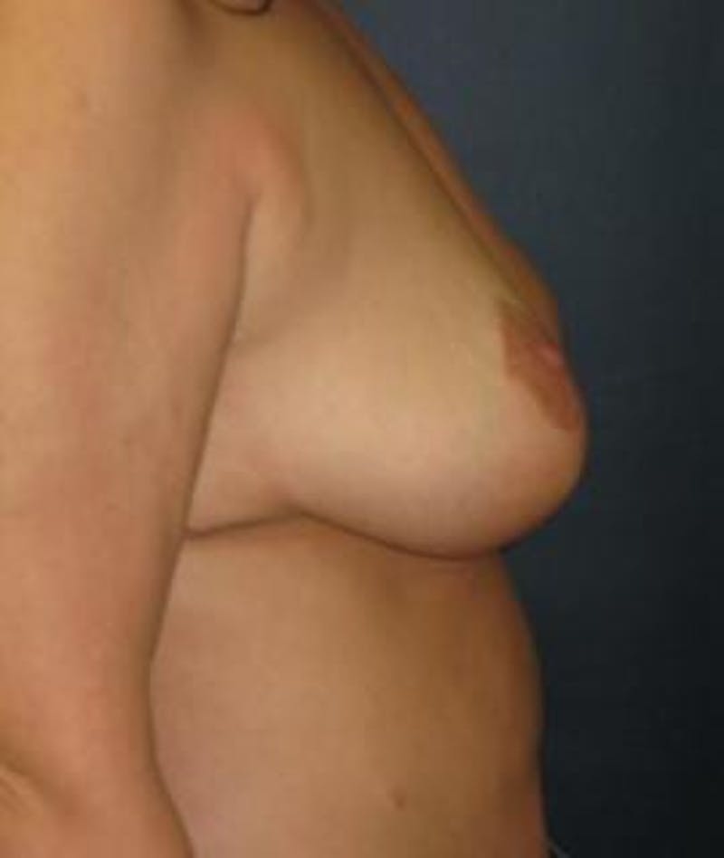 Breast Reduction Before & After Gallery - Patient 189809 - Image 4