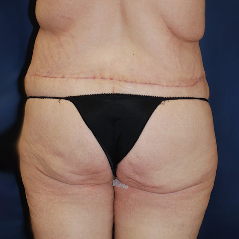 Body Lift Before & After Gallery - Patient 741256 - Image 4