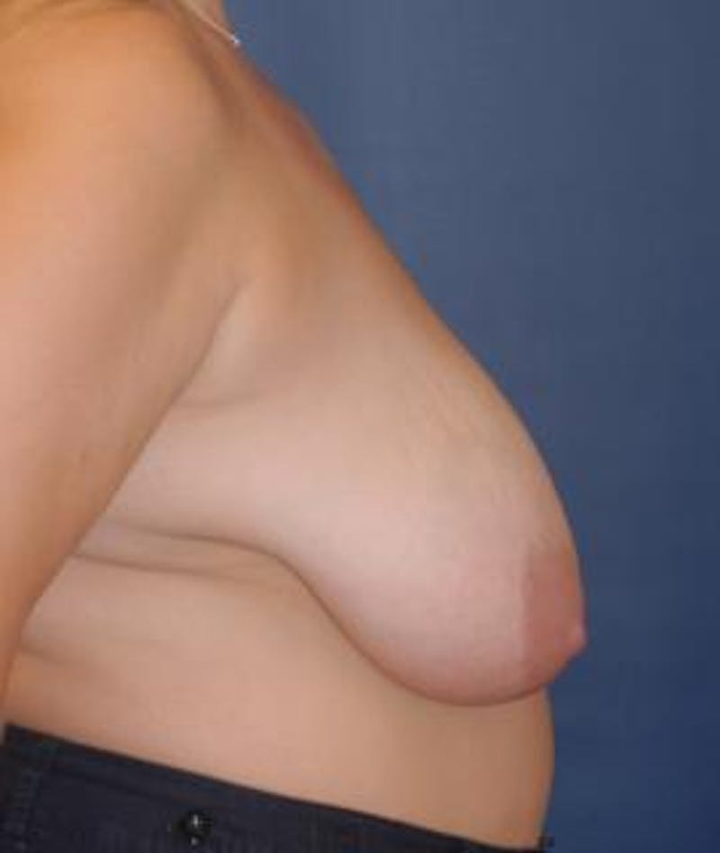 Breast Reduction Before & After Gallery - Patient 189809 - Image 3