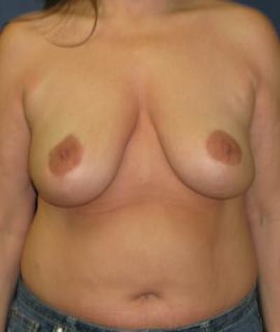 Breast Reduction Before & After Gallery - Patient 189809 - Image 2