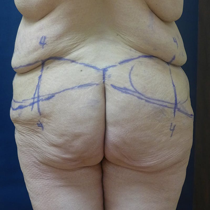 Body Lift Before & After Gallery - Patient 741256 - Image 3