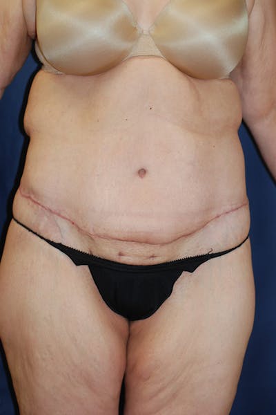 Body Lift Before & After Gallery - Patient 741256 - Image 2