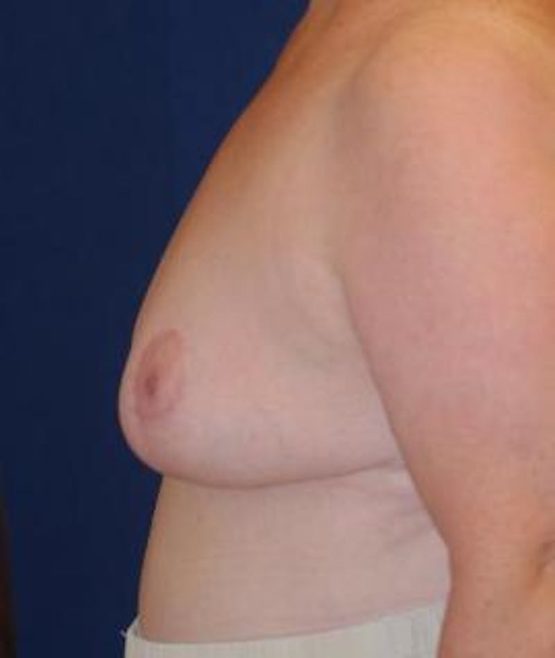 Breast Reduction Before & After Gallery - Patient 321618 - Image 4