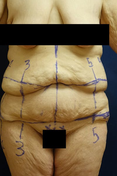 Body Lift Before & After Gallery - Patient 741256 - Image 1
