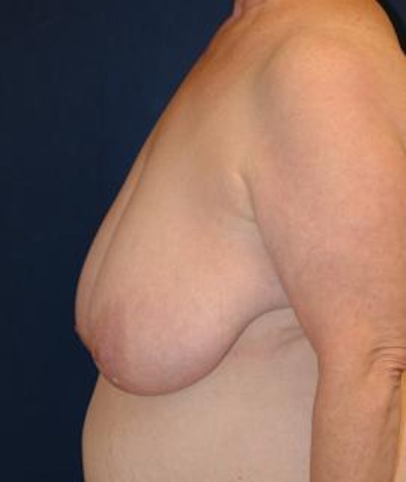 Breast Reduction Before & After Gallery - Patient 321618 - Image 3