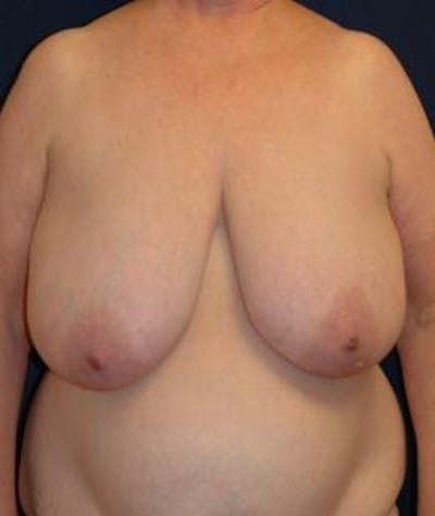 Breast Reduction Before & After Gallery - Patient 321618 - Image 1