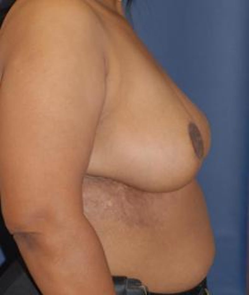 Breast Reduction Before & After Gallery - Patient 159519 - Image 4