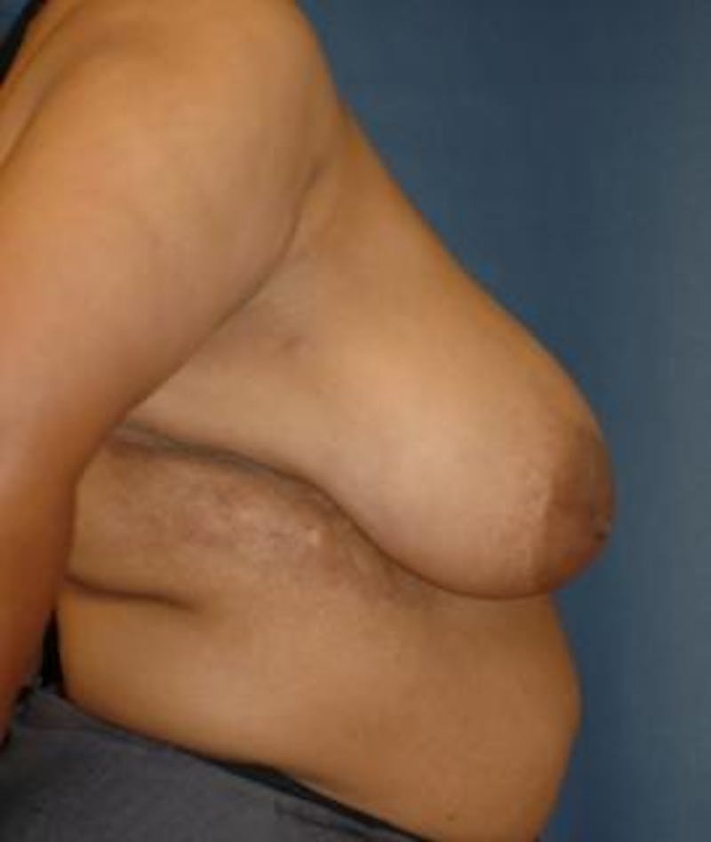 Breast Reduction Before & After Gallery - Patient 159519 - Image 3