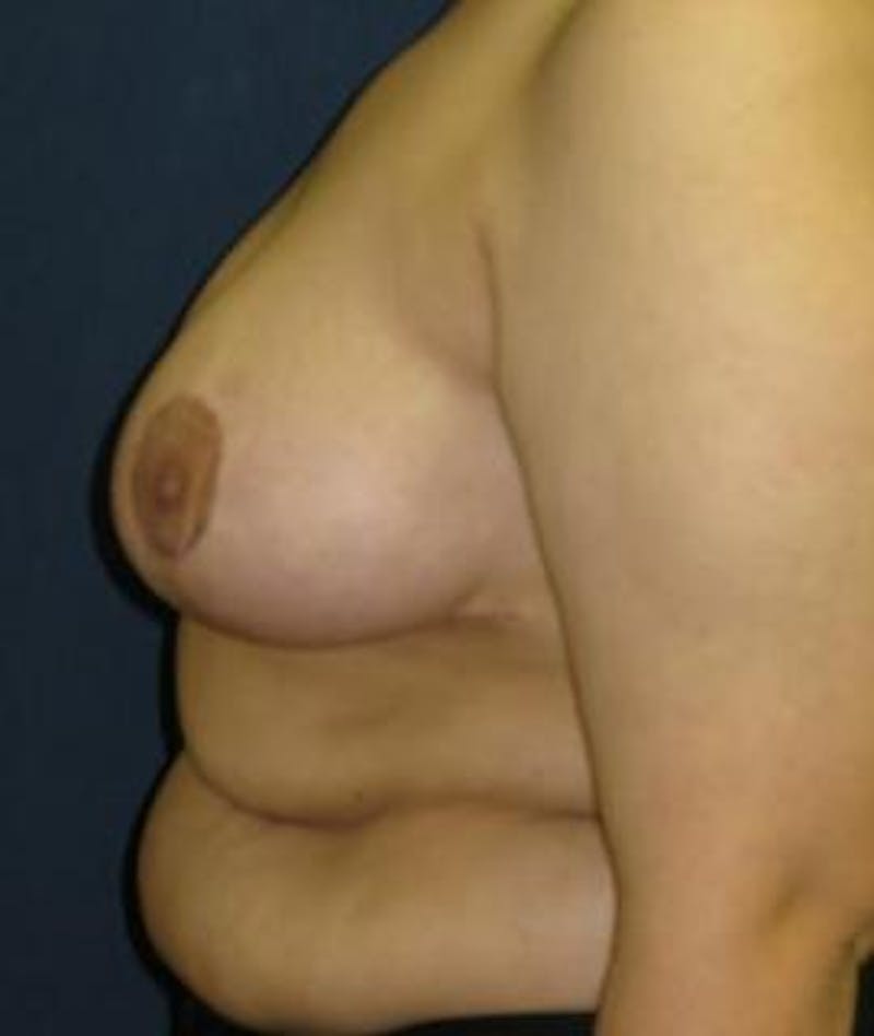 Breast Reduction Before & After Gallery - Patient 111421 - Image 4