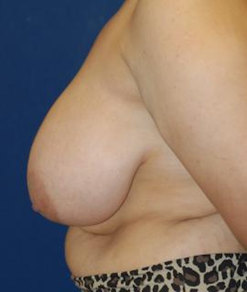 Breast Reduction Before & After Gallery - Patient 111421 - Image 3