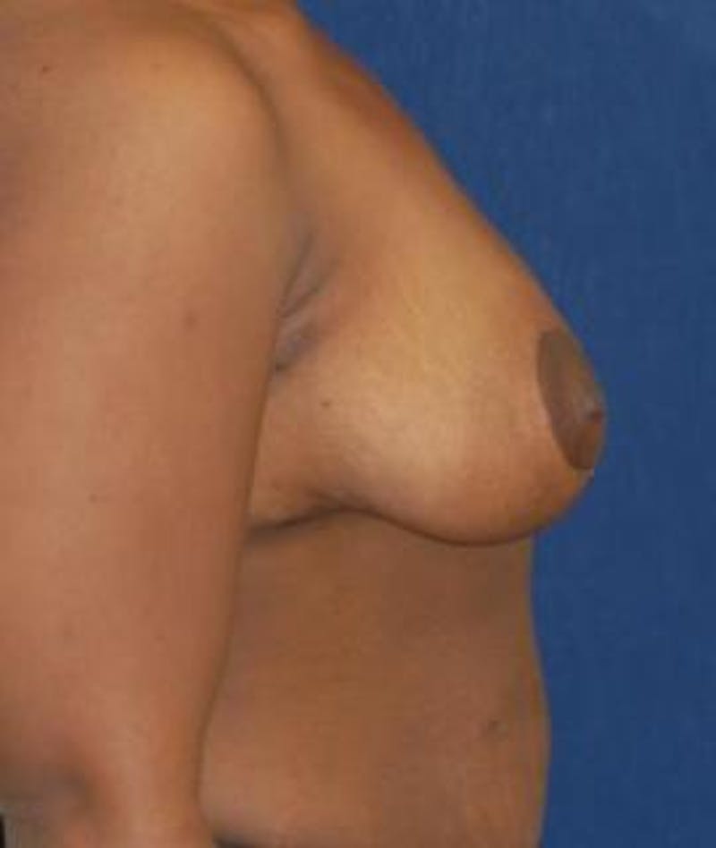 Breast Reduction Before & After Gallery - Patient 409514 - Image 4