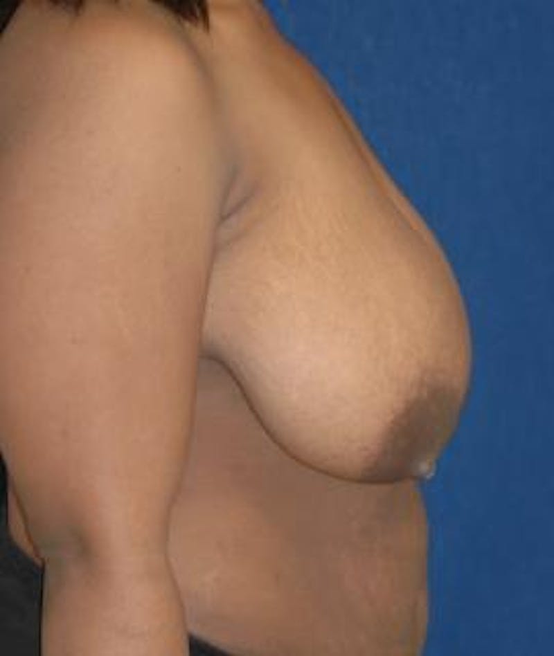 Breast Reduction Before & After Gallery - Patient 409514 - Image 3