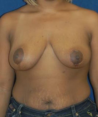 Breast Reduction Before & After Gallery - Patient 409514 - Image 2