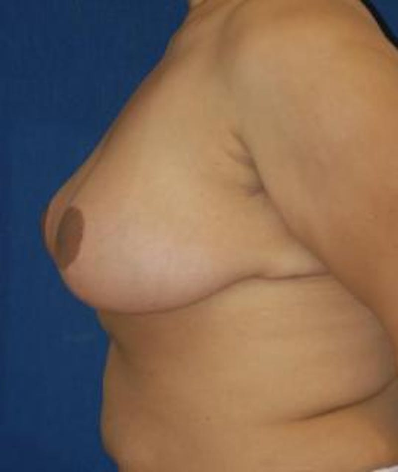 Breast Reduction Before & After Gallery - Patient 232316 - Image 4