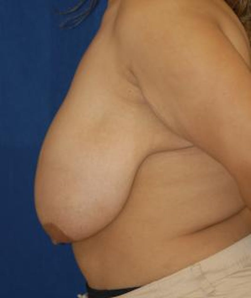 Breast Reduction Before & After Gallery - Patient 232316 - Image 3