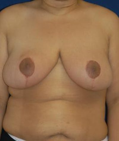 Breast Reduction Before & After Gallery - Patient 232316 - Image 2