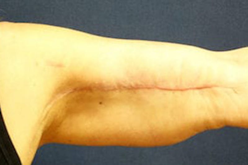 Arm Lift (Brachioplasty) Before & After Gallery - Patient 412957 - Image 4