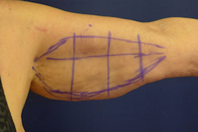 Arm Lift (Brachioplasty) Before & After Gallery - Patient 412957 - Image 3