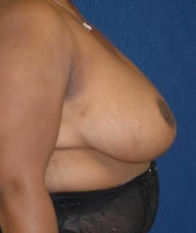 Breast Reduction Before & After Gallery - Patient 137959 - Image 4