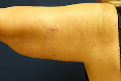 Arm Lift (Brachioplasty) Before & After Gallery - Patient 412957 - Image 2