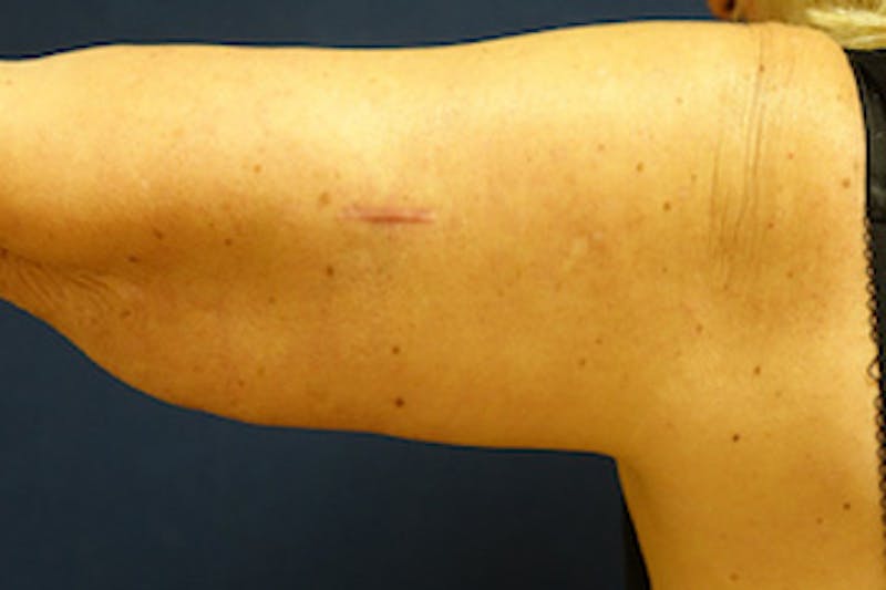 Arm Lift (Brachioplasty) Before & After Gallery - Patient 412957 - Image 2