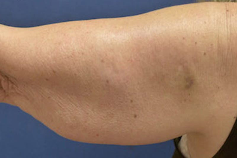 Arm Lift (Brachioplasty) Before & After Gallery - Patient 412957 - Image 1