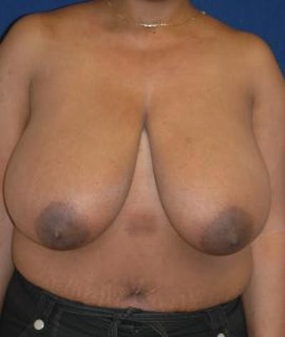 Breast Reduction Before & After Gallery - Patient 137959 - Image 1