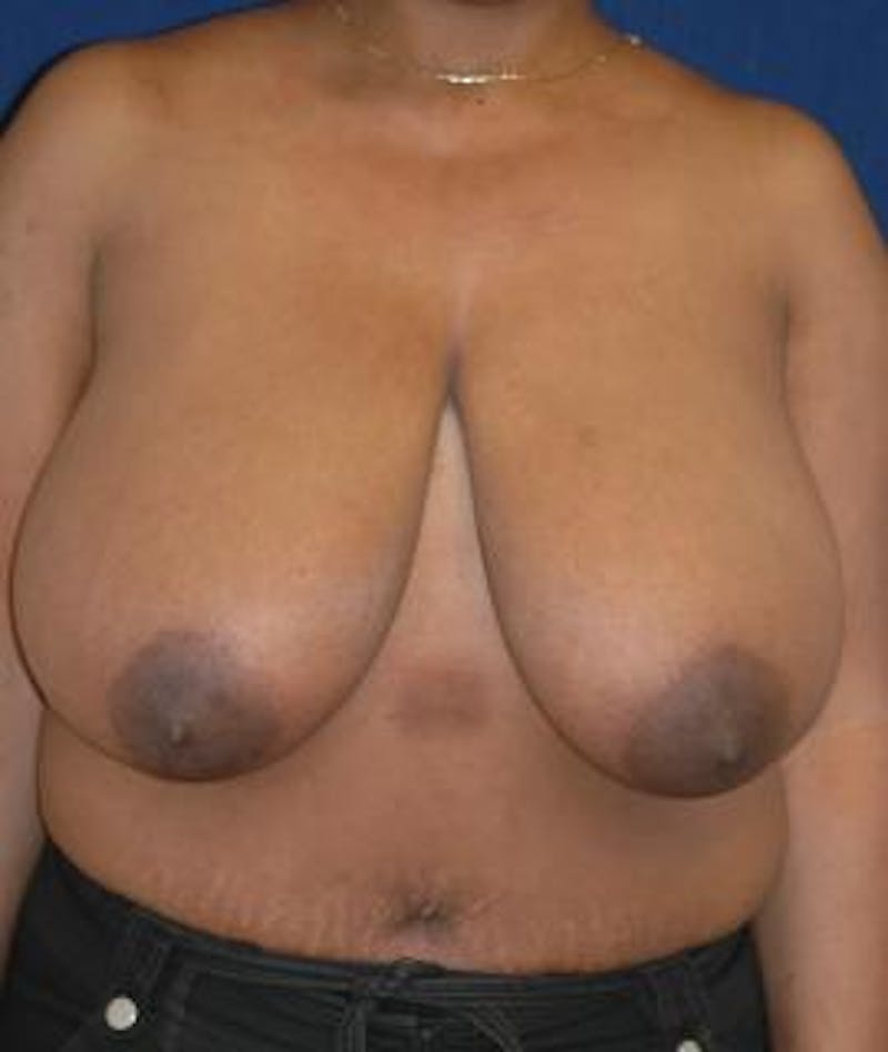 Breast Reduction Before & After Gallery - Patient 137959 - Image 1
