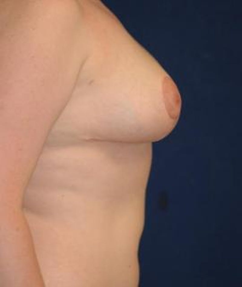 Breast Reduction Before & After Gallery - Patient 574532 - Image 4