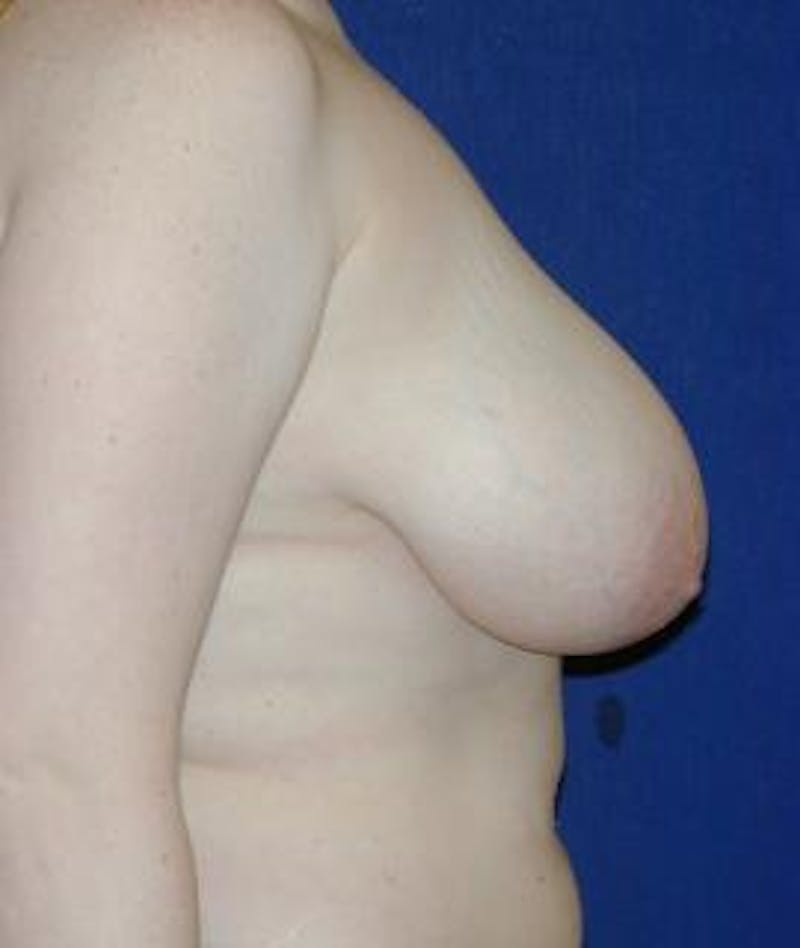Breast Reduction Before & After Gallery - Patient 574532 - Image 3
