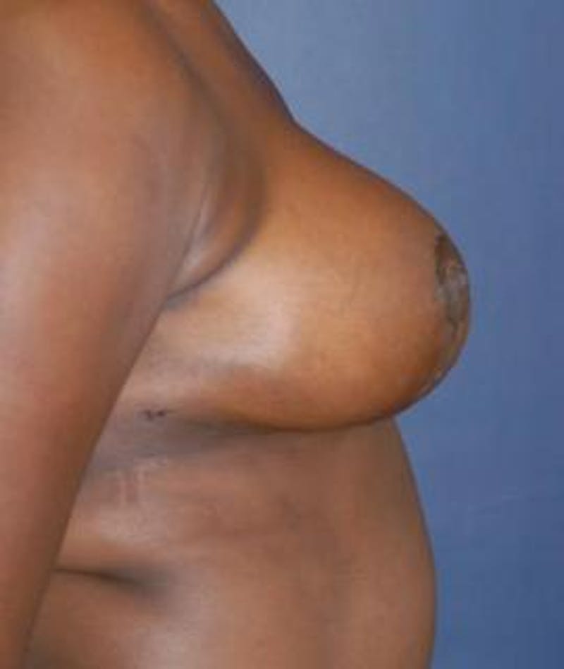 Breast Reduction Before & After Gallery - Patient 532924 - Image 4