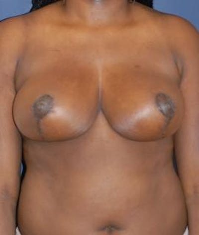 Breast Reduction Before & After Gallery - Patient 532924 - Image 2