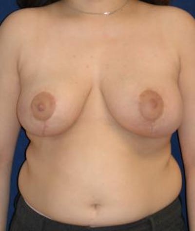 Breast Reduction Before & After Gallery - Patient 576284 - Image 2