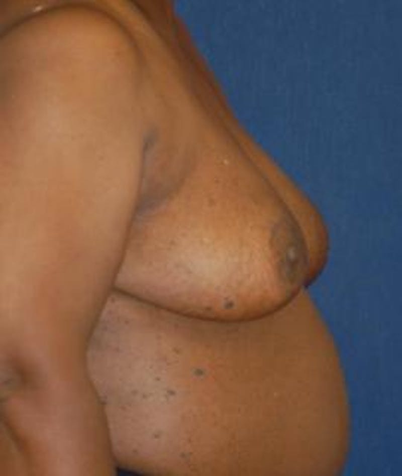 Breast Reduction Before & After Gallery - Patient 956455 - Image 4