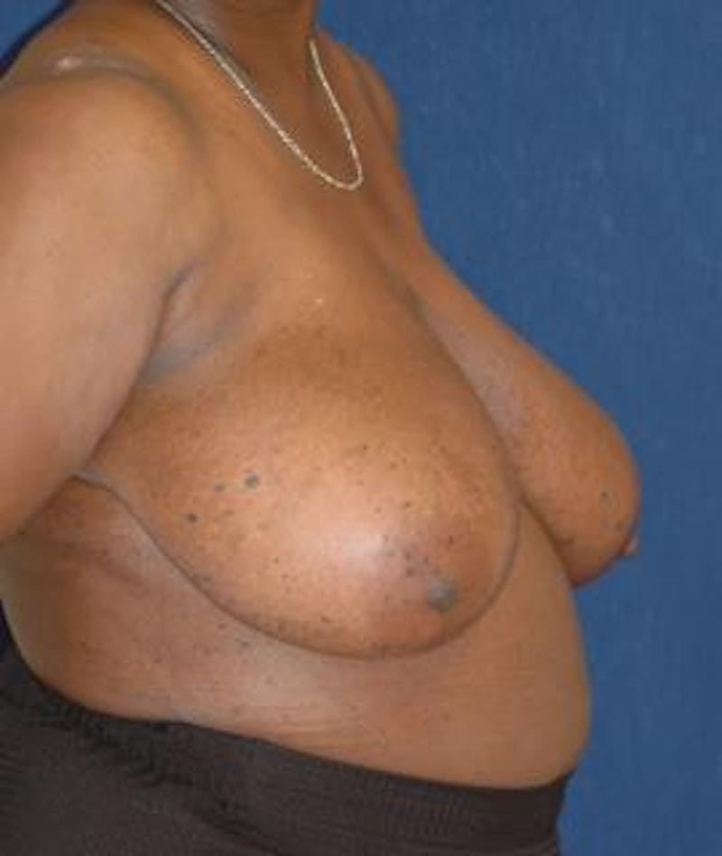 Breast Reduction Before & After Gallery - Patient 956455 - Image 3