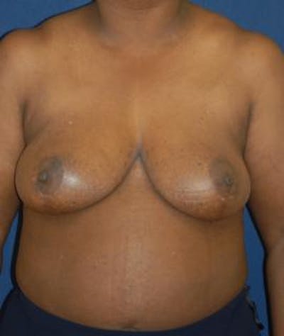 Breast Reduction Before & After Gallery - Patient 956455 - Image 2