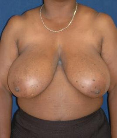 Breast Reduction Before & After Gallery - Patient 956455 - Image 1
