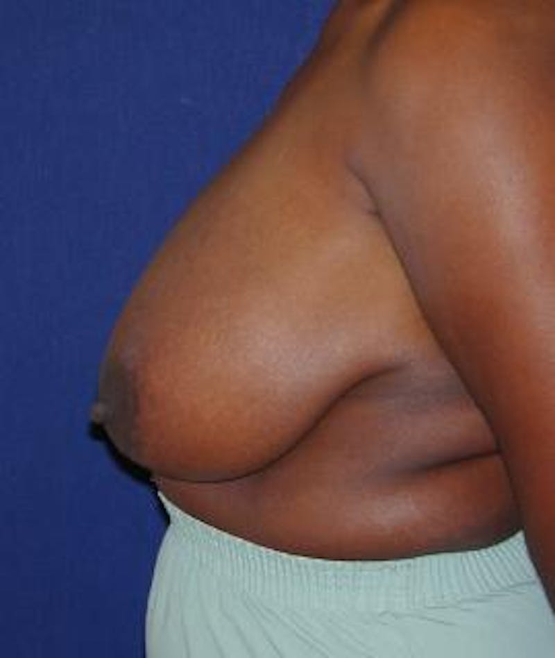 Breast Reduction Before & After Gallery - Patient 310921 - Image 3