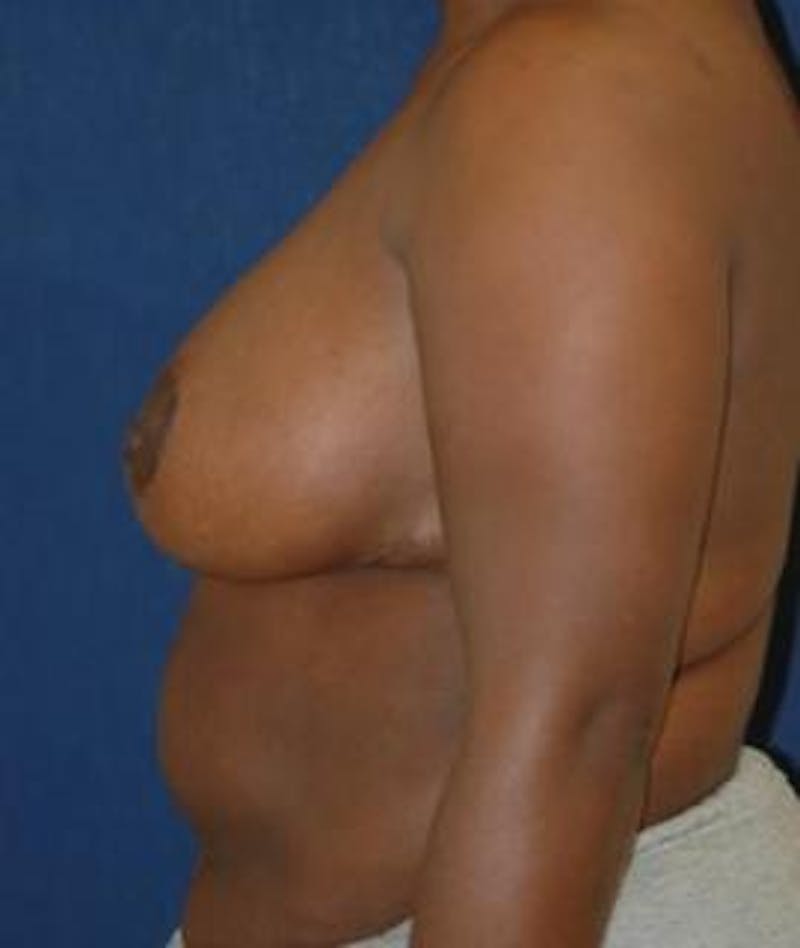 Breast Reduction Before & After Gallery - Patient 310921 - Image 4