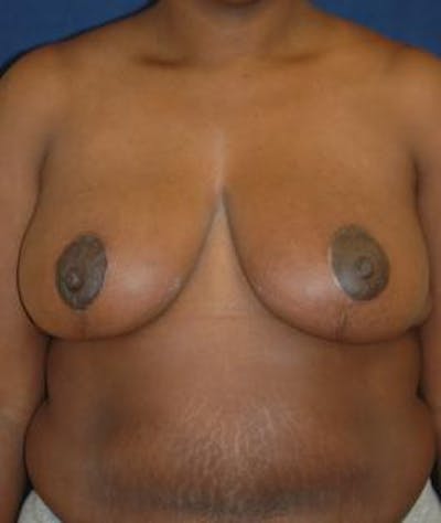 Breast Reduction Before & After Gallery - Patient 310921 - Image 2
