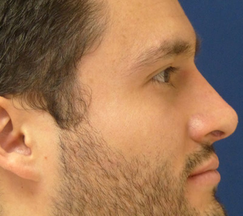 Rhinoplasty Before & After Gallery - Patient 390179 - Image 6