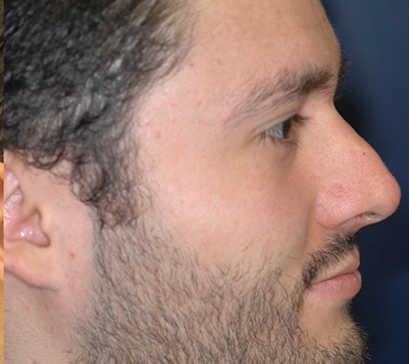 Rhinoplasty Before & After Gallery - Patient 390179 - Image 5