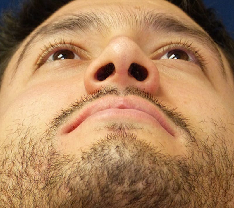 Rhinoplasty Before & After Gallery - Patient 390179 - Image 4