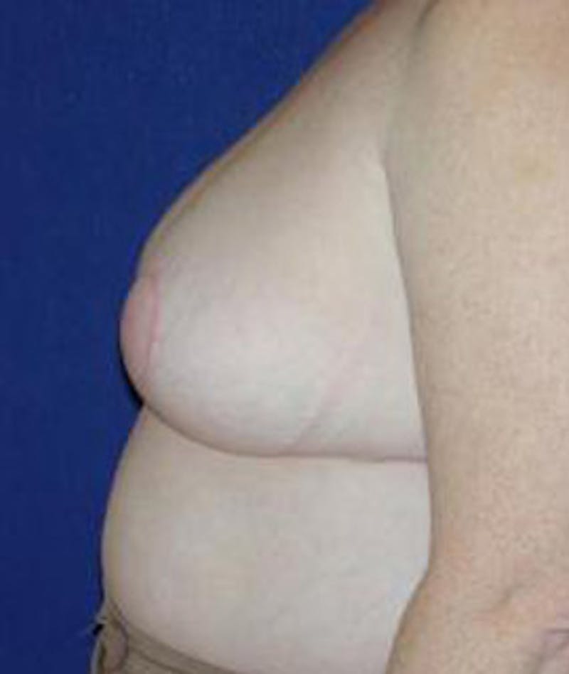Breast Reduction Before & After Gallery - Patient 284066 - Image 4