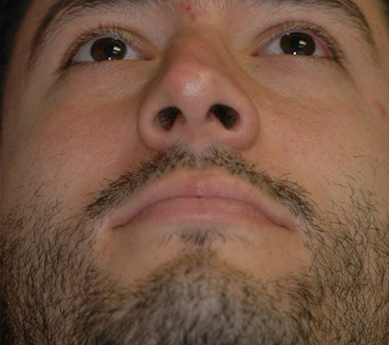 Rhinoplasty Before & After Gallery - Patient 390179 - Image 3