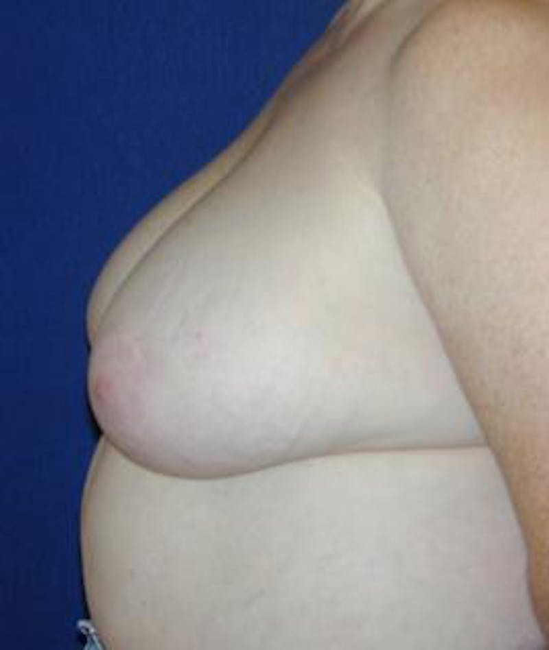 Breast Reduction Before & After Gallery - Patient 284066 - Image 3